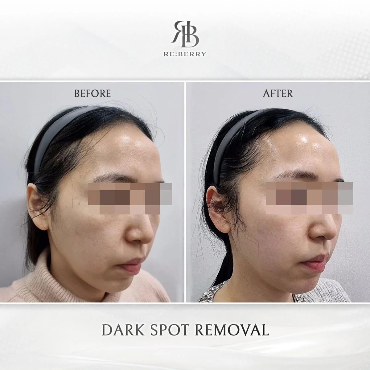 Melasma treatment before after showing cheek melasma improvement Korea